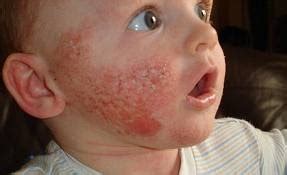 Why Are The Little Babies Weeping: A Summary Of Some Common Skin Rashes In Babies