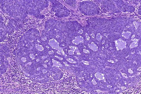 Adenoid Basal Cell Carcinoma Histology