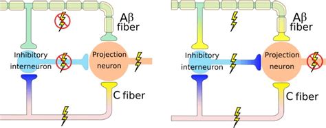 The Gate-Control Theory And How It Alleviates Pain Following ...