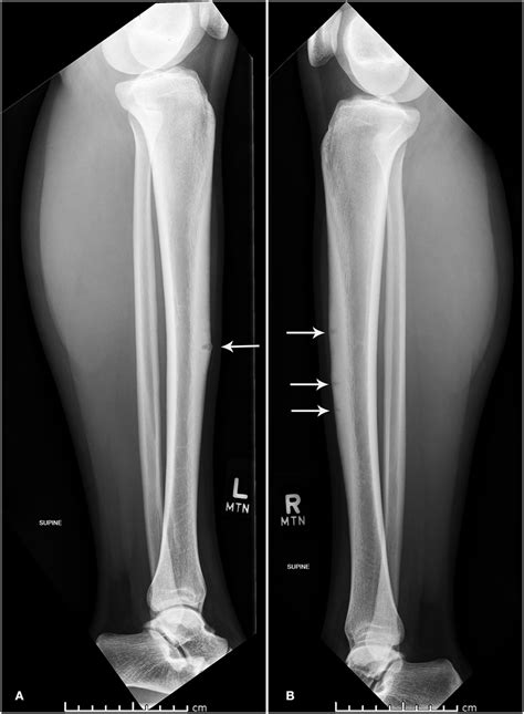 | Lateral x-ray of left (A) and right (B) tibia and fibula. | Download Scientific Diagram