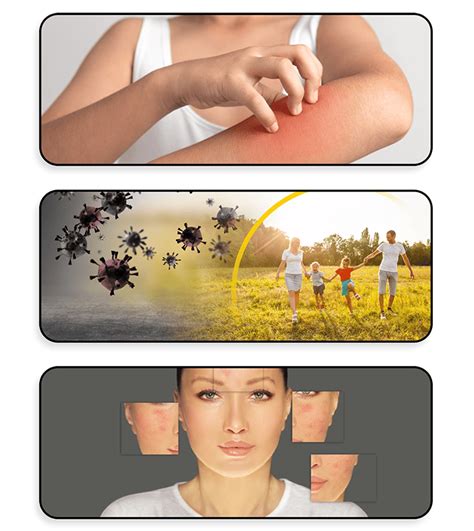 Effective Psoriasis Treatment | Experience Relief at Our Skin Care Hospital | Treatment for ...