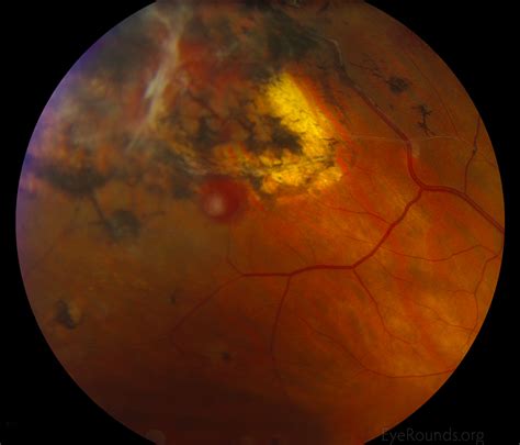 Atlas Entry - Retinal hemangioblastoma associated with Von-Hippel Lindau syndrome