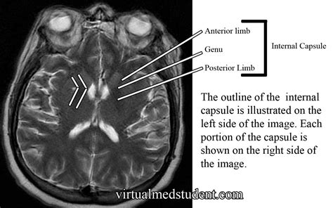 Internal Capsule | Internal capsule, Capsule, Medical pictures