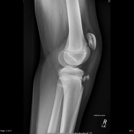 Tibial avulsion fracture - secretsukraine