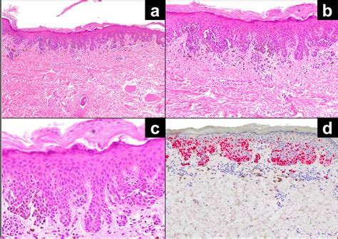 The final diagnosis was a dysplastic compound nevus with severe atypia,... | Download Scientific ...