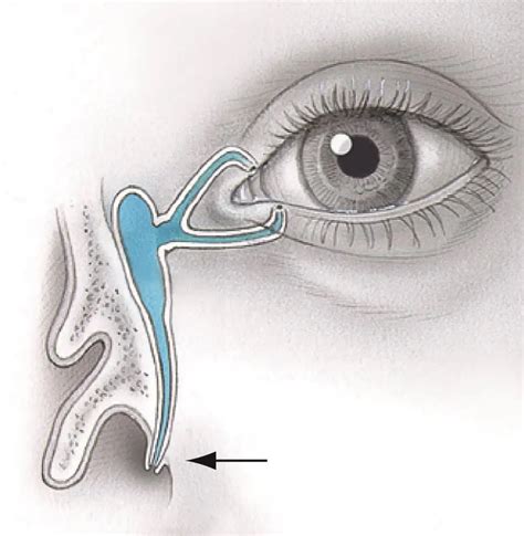 Nasolacrimal duct obstruction anatomy - American Academy of Ophthalmology