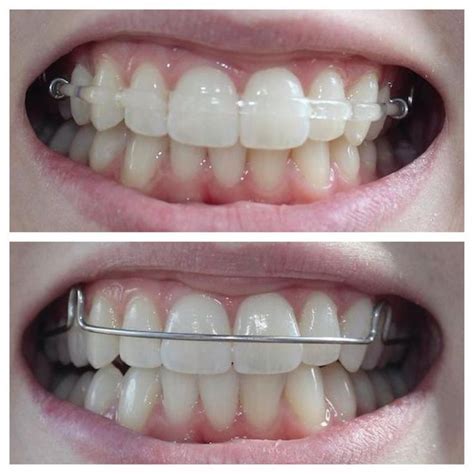 Clear retainers: Teeth straightening beyond braces orthodontistcriti... - #braces #clear # ...