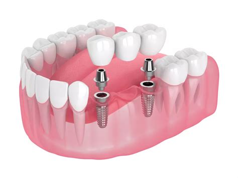 Dental Implants with Guided Tooth Implant Placement