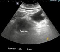 Acute Pancreatitis Secondary to Diabetic Ketoacidosis Induced Hypertriglyceridemia in a Young ...