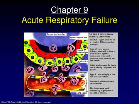 PPT - Chapter 9 Acute Respiratory Failure PowerPoint Presentation, free ...