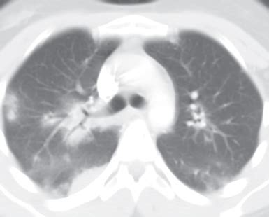 107 Eosinophilic Pneumonia | Radiology Key