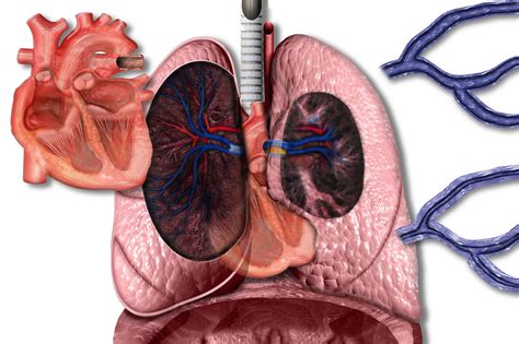 Early Triple Combination Therapy With Selexipag Stabilizes Functional Class in PAH/CTEPH - The ...