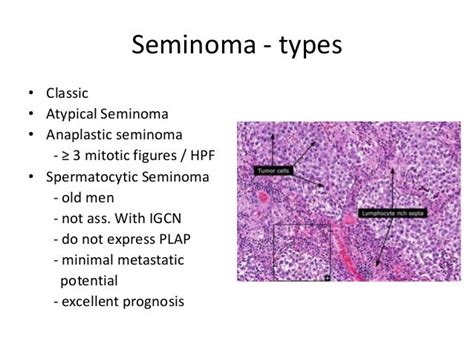 Seminoma