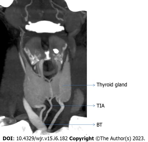 Showing origin of thyroid ima artery from the brachiocephalic trunk.... | Download Scientific ...