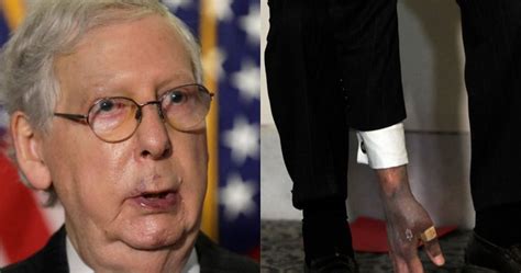 Mitch McConnell’s mysteriously bruised hands spark health questions ...