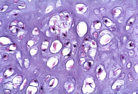 Pathology Outlines - Enchondroma