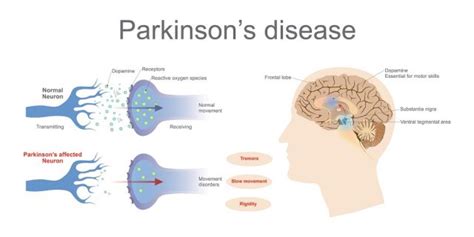 Degenerative Nerve Disease: Types, Causes | STD.GOV Blog