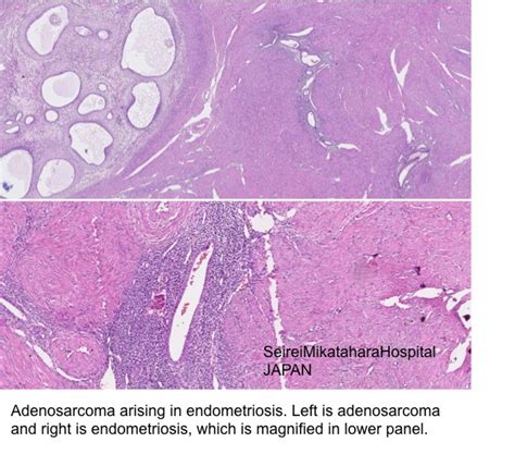 Pathology Outlines - Adenomyosis