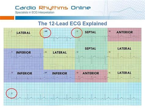 There are tons of videos on YouTube on how to interpret an EKG/ ECG. Description from pinterest ...