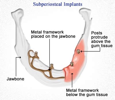 Types of Dental Implants: Endosteal, Transosteal & Subperiosteal | Dr. Hassan El-Awour's Dental ...