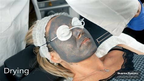 Laser Carbon Peel Treatment | 100% Natural Peel