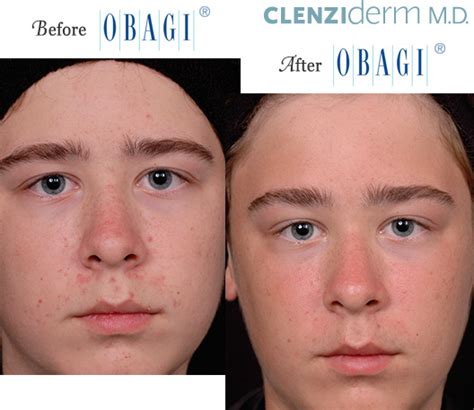 Obagi® Before and After Pictures – Micki Ly M.D. Maui Dermatologist