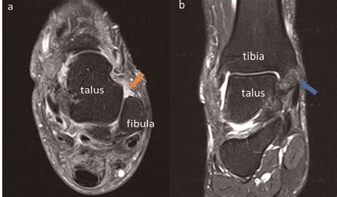 Mri Ankle Anatomy Ligaments