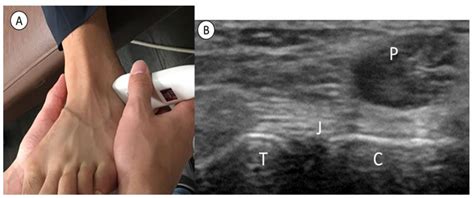 Healthcare | Free Full-Text | Ultrasound Imaging of Subtalar Joint Instability for Chronic Ankle ...