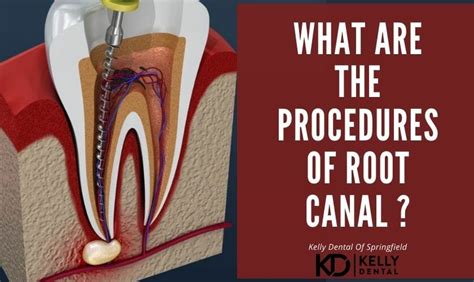 The Procedure Of Root Canal Treatment