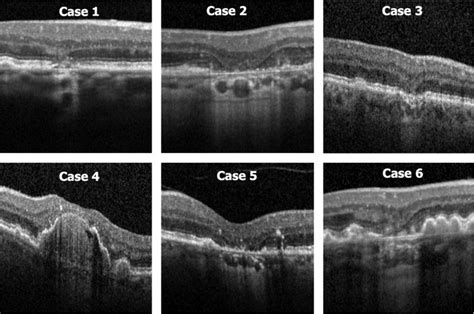 Consensus Definition for Atrophy Associated with Age-Related Macular ...