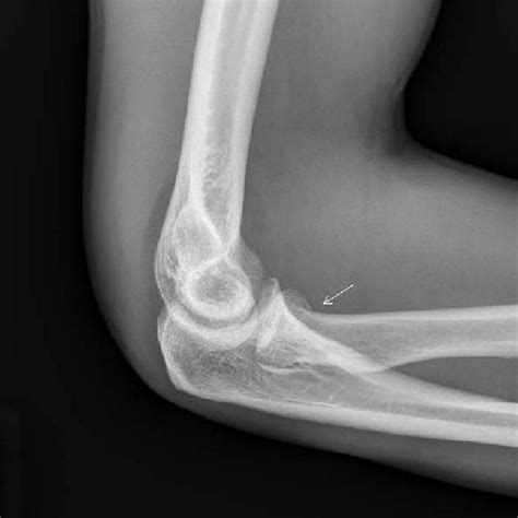 Right elbow repair fx xray photo - stormchrome