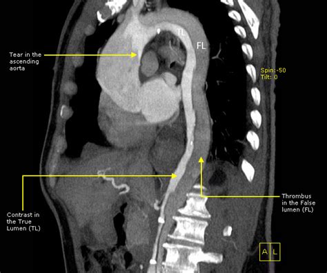 Aortic Dissection - RCEMLearning