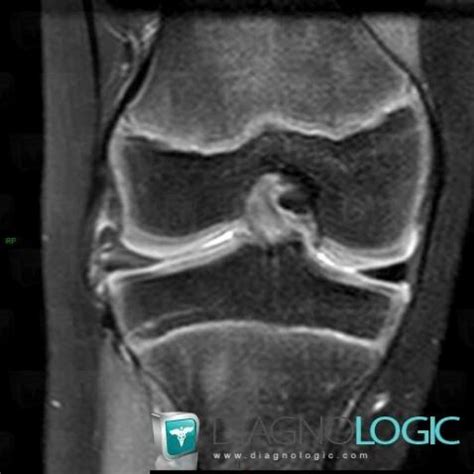 Radiology case : Discoid meniscus (MRI) - Diagnologic