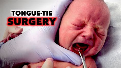 TONGUE-TIE SURGERY on NEWBORN (Frenotomy) | Dr. Paul - YouTube