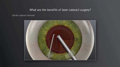 Catalys Laser Cataract Surgery - Animation - YouTube