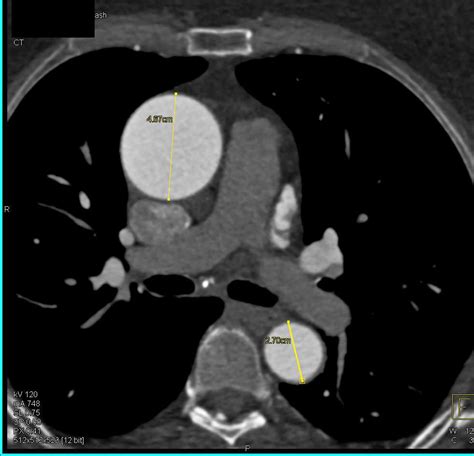 Dilated Ascending Aorta with Normal Aortic Valve Leaflets - Cardiac Case Studies - CTisus CT ...