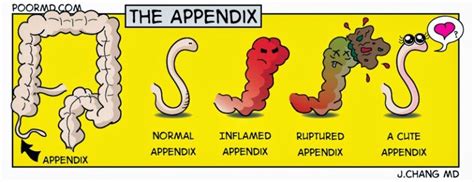 Appendicitis Cartoon – poormd.com