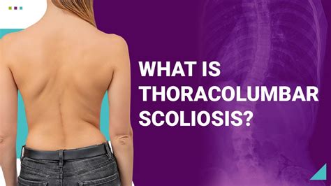 What is Thoracolumbar Scoliosis? - YouTube