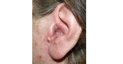 Otitis externa - www.medicoapps.org