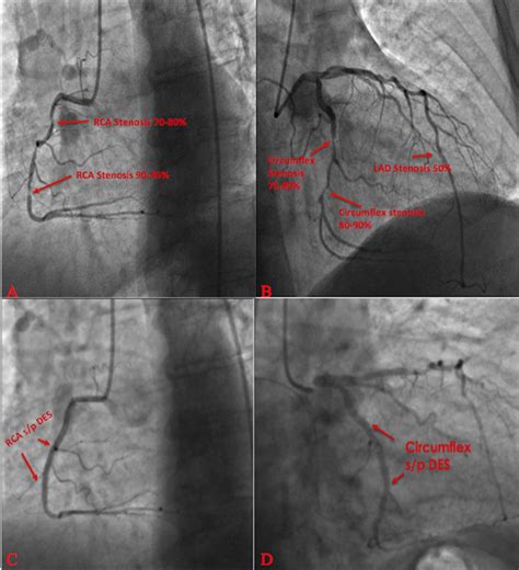 Cardiac Catheterization