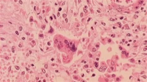 Measles case confirmed in Chicago resident, health officials say – NBC Chicago