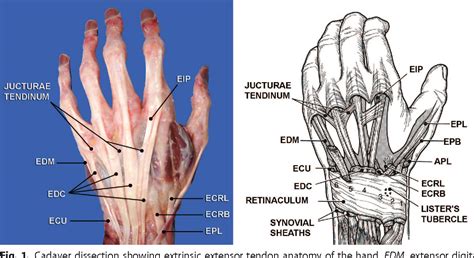 Thumb Extensor Tendonitis