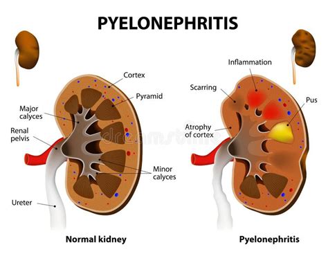 Pielonefritis ilustración del vector. Ilustración de medicina - 51792876