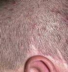 10 Home Remedies for Scalp Folliculitis - Home Remedies - Natural & Herbal Cures Made at ...