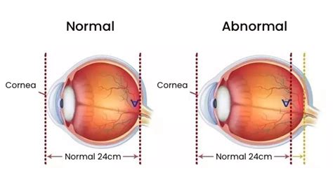 What is CYL, AXIS and SPH in eye prescription? | Lensmart Online