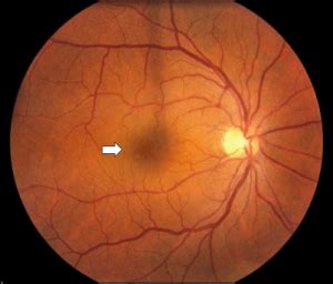 A Detailed Study on Cystoid Macular Oedema, Diagnosis, Treatment