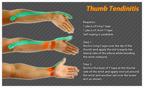 Kinesiology taping instructions for tendinitis of the thumb #ktape #ares #tendinitis #thumb ...