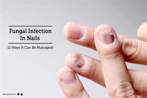 Fungal Infection In Nails - 11 Ways It Can Be Managed! - By Dr. Niraj Goenka | Lybrate