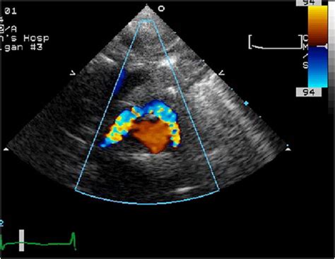 A 21-year-old male with D-TGA status post arterial switch surgery. High... | Download Scientific ...