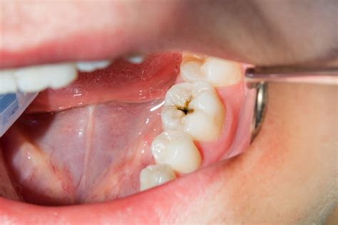 What Happens If You Don’t Treat a Cavity? A Dentist Explains